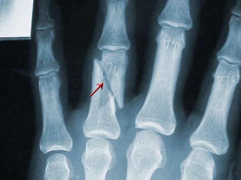 Cool X-rays | Broken Finger (cont.) Fractured Finger, Finger Cartoon, H D Carlton, Broken Finger, Emt Paramedic, Broken Arm, X Rays, Mirror House, Human Anatomy Art