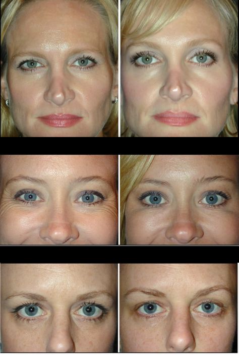 Before you go under the knife for sagging eyebrows, Botox might be just the answer you need!  Learn how you can use Botox to safely lift in your brow in this Medical Minute. Brow Lift Botox Before And After, Eyebrow Botox Lift, Botox For Eyebrow Lift, Eyelid Lift Before After, Eyebrow Lift Before And After, Brow Lift Botox Eyebrows, Botox Eyebrow Lift Before And After, Brow Lift Before And After, Eyebrow Lift Botox Before And After