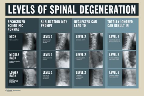 Levels of Spinal Degeneration Backache Remedies, Spine Images, Spinal Degeneration, Severe Neck Pain, Human Body Facts, Spinal Fusion, Cerebrospinal Fluid, Diagnostic Imaging, Spine Health