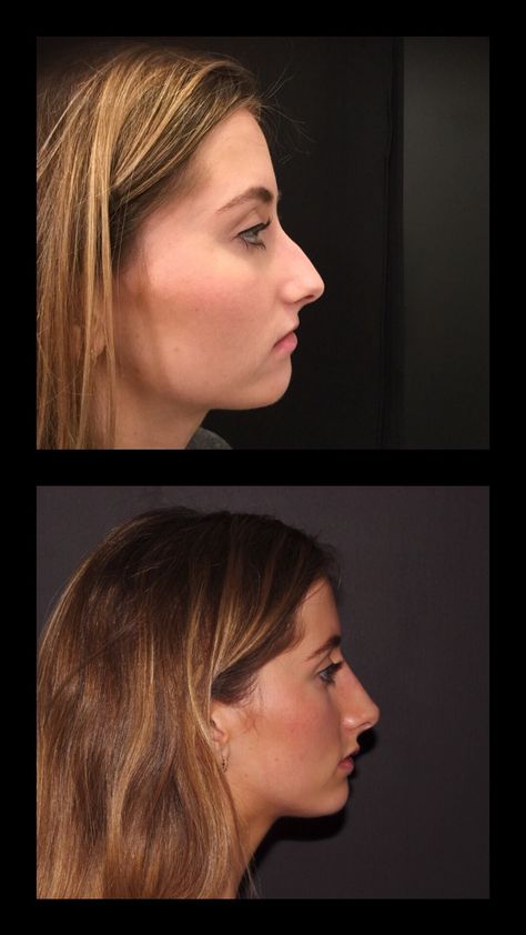 Nose Job Before And After Bump, Nose Injections Before And After, Non Surgical Nose Job Before After, Filler Nose Job Before After, Nose Job Before And After Front View, Botox Nose Before After, Nose Before And After, Liquid Nose Job Before And After, Nose Job Before And After Rhinoplasty