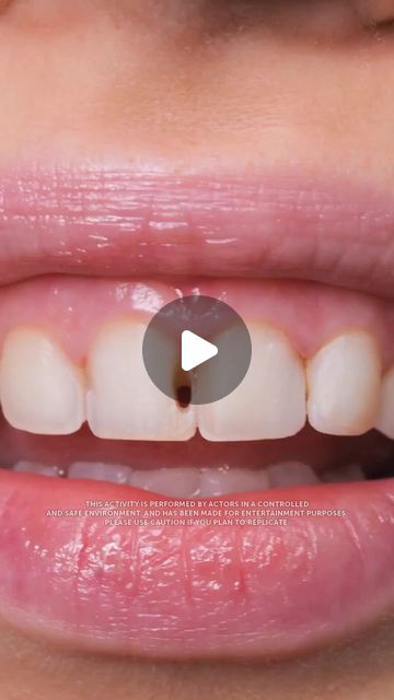 5-Minute Crafts on Instagram: "Composite veneers! How to restore a smile in one go. #hollywoodsmile #veneers #compositeveneers #beautymakeover #dentistry" Composite Veneers Before And After, Veneers Teeth Styles, Veneers Before And After, Composite Veneers, Veneers Teeth, Porcelain Veneers, Restorative Dentistry, Beauty Makeover, 5 Min Crafts