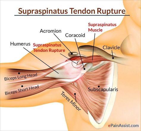 Supraspinatus Muscle, Shoulder Anatomy, Shoulder Rehab, Shoulder Surgery, Human Body Anatomy, Muscle Anatomy, Medical Anatomy, Rotator Cuff, Body Anatomy