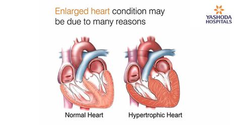 Enlarged Heart: Heart Enlargement Causes | Signs of Enlarged Heart Heart Symptoms, Enlarged Heart, Throbbing Headache, Normal Heart, Congenital Heart, Heart Care, Heart Conditions, Migraine Headaches, Health Knowledge