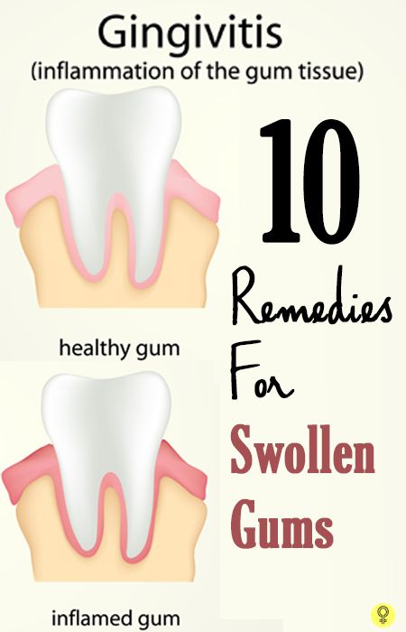 Do you suffer from swollen gums? If you do, you probably often go through a lot of discomfort and pain. Here are some effective home remedies for you to know Swollen Gum, Teeth Health, Receding Gums, Gum Health, Holistic Remedies, Oral Health Care, Simple Home, Tooth Decay, Healthy Teeth