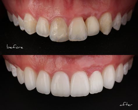 Smile Stylist Before and After Porcelain Veneers Dental Veneers Before And After, Teeth Study, Veneers Teeth, Dental Anatomy, Porcelain Veneers, Perfect Teeth, Dental Veneers, Dental Art, Smile Makeover