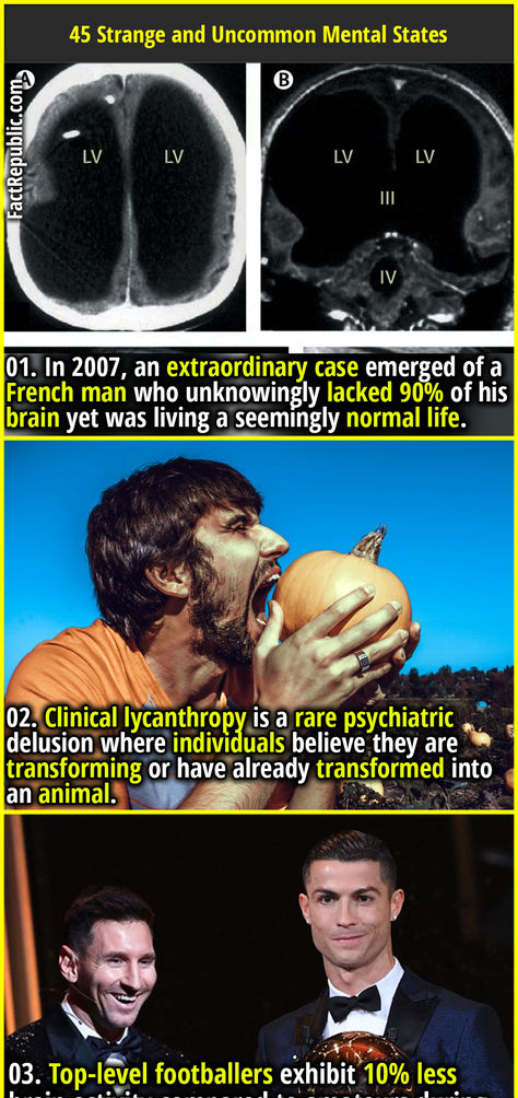 01. In 2007, an extraordinary case emerged of a French man who unknowingly lacked 90% of his brain yet was living a seemingly normal life. Cryptid Facts, Random Useless Facts, Terrifying Facts, Fun Facts Scary, Human Physiology, Fun Stories, Fact Republic, Unusual Facts, Brain Facts