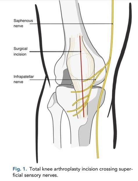 What Wear After Knee Replacement Surgery Siatic Nerve, After Knee Replacement Surgery, Knee Replacement Recovery, Peripheral Nerve, Knee Replacement Surgery, Orthopedic Surgery, Knee Pain Relief, Knee Surgery, Knee Replacement