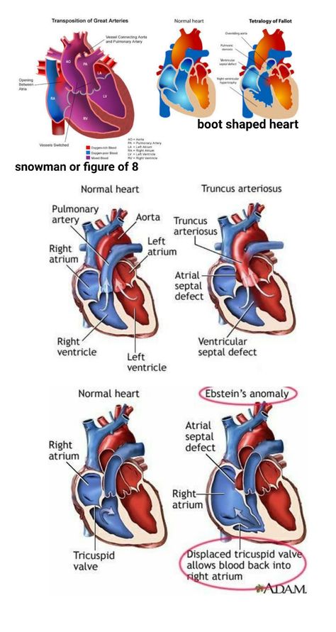 #TOF #TGA #Truncus arteriosus #Ebstein anomaly Phlebotomy Scrubs, Ebstein Anomaly, Truncus Arteriosus, Nursing Terminology, Mri Anatomy, Med School Prep, Cardiac Sonography, Medical Assistant Student, Heart Diagram