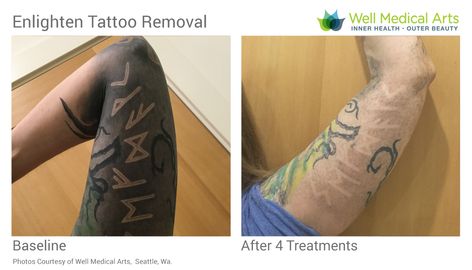 More amazing laser tattoo removal before and after photos from Well Medical Arts in Seattle.  Call 206-935-5689 to schedule your consultation to get started removing that tattoo. Go Tattoo, Tattoo Removal Cost, 12 Tattoos, Green Tattoos, Omerta Tattoo, Web Tattoo, Healing Tattoo, Laser Tattoo, Laser Tattoo Removal