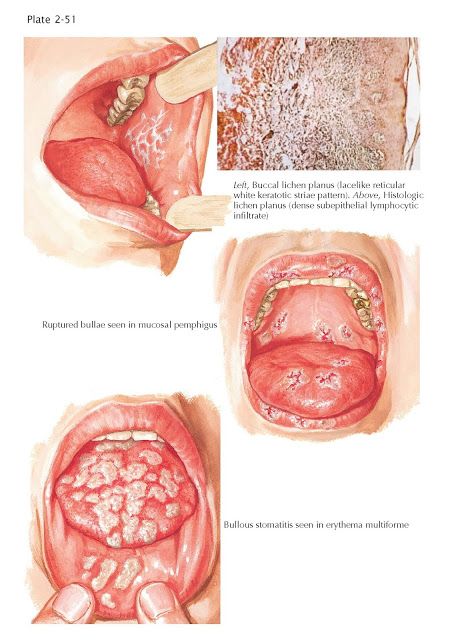 Oral Manifestations in Various Skin Conditions   A great number of pathologic conditions of the skin have accompanying oral manifestation... Langerhans Cell Histiocytosis, Langerhans Cell, Steven Johnson Syndrome, Tuberous Sclerosis, Oral Pathology, Dental World, Basal Cell, Restorative Dentistry, Medical Knowledge