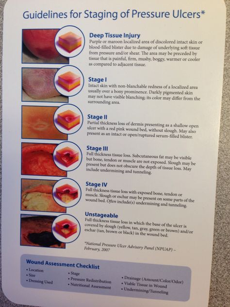 Staging Pressure  Ulcers Wound Assessment, Pressure Ulcer Staging, Wound Care Nurse, Wound Care Nursing, Medical Assisting, Nursing Information, Nursing Assessment, Bed Sores, Pressure Ulcer