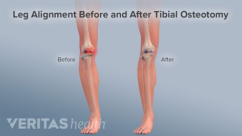 A knee osteotomy can change bone alignment so that the mechanical axis passes though the center of the knee and weight is more evenly distributed. This can help avoid further joint degeneration. Bow Legged Correction, Knock Knees, Homemade Body Care, Bow Legged, Knee Surgery, Health Trends, Feeling Happy, Going Crazy, Knock Knock