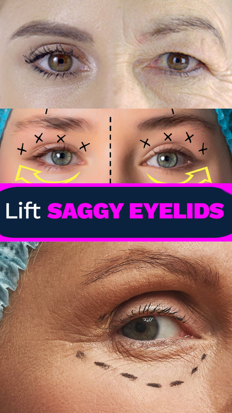 Eye Lid Lift Droopy Eyelids, Makeup For Droopy Eyelids, Saggy Eyes, Saggy Eyelids, Dark Spots Under Eyes, Droopy Eyelids, Droopy Eyes, Eyelid Lift, Beauty Expert