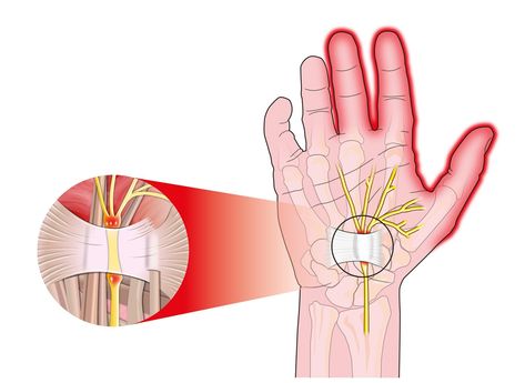 “My tingling hands wake me up at night!” — Joseph J. Schreiber, MD Tingling In Fingers, Numbness In Fingers, Tingling Hands, Shoulder Muscle Pain, Carpal Tunnel Exercises, Carpal Tunnel Surgery, Numbness In Hands, Bursitis Hip, Median Nerve