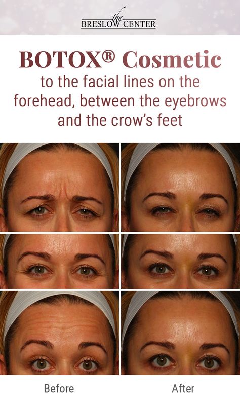 Procedure: BOTOX® Cosmetic to the facial lines on the forehead, between the eyebrows and the crow’s feet. Dr. Breslow and Dr. Farkas have performed hundreds of procedures at our private surgical center in Paramus, NJ, exceeding our patients’ expectations. For natural results like these, give us a call at (201) 444-9522. Botox Forehead, Botox Results, Face Procedures, Paramus Nj, Botox Before And After, Botox Lips, Botox Cosmetic, Facial Contouring, Botox Injections