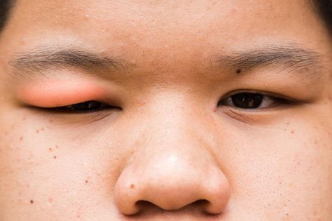 12 causes and treatments of a swollen eyelid: Stye, chalazion, allergies Swollen Eyes Remedy, Swollen Eyelids Remedy, Swollen Eye Remedies, Swollen Eye, Eye Stye Remedies, Swollen Eyelid, Overnight Acne Remedies, Swollen Eyes, Dry Eye