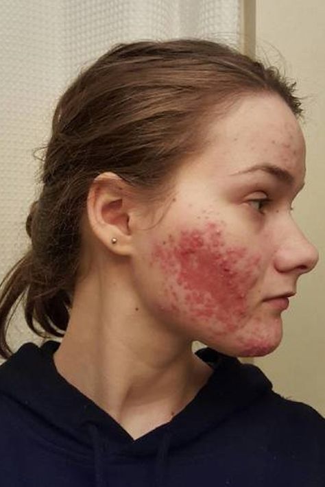 Girl With Acne, Covering Acne, Cystic Acne Treatment, Acne Overnight, Greasy Skin, Acne Vulgaris, Natural Acne, Types Of Acne, Severe Acne