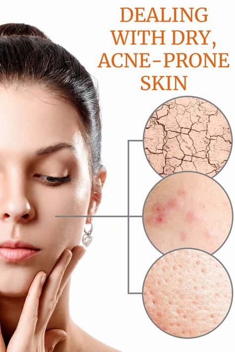 Should you moisturize acne prone skin? Can dry skin cause acne? Read on to learn more about dry, acne prone skin and how to treat it naturally. Dry Acne Prone Skin, Dry Skin Causes, Sensitive Skin Care Routine, Acne Prone Skin Care, Facial Aesthetics, Sensitive Skin Care, Natural Cream, Acne Skin, Acne Prone Skin