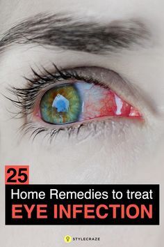 25 Effective Home Remedies To Treat Eye Infection Dry Eyes Causes, Swollen Eyes, Irritated Eye, Allergy Remedies, Human Eyes, Eye Infections, Dry Eye, Sore Eyes, Eyes Problems