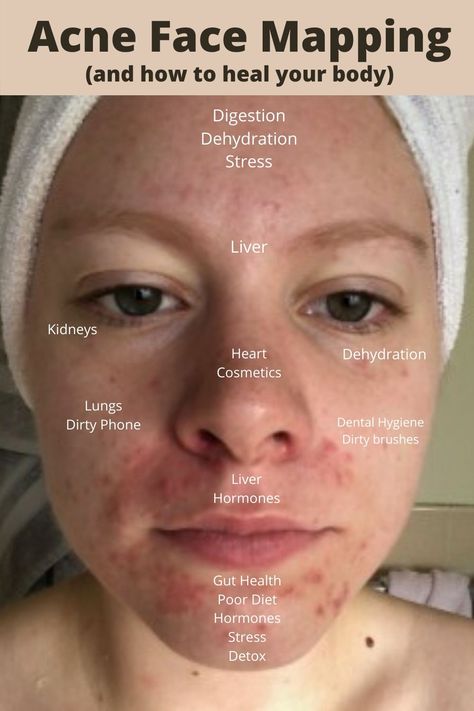 Face Acne Remedies, Acne Face Map, Face Map, Cystic Acne Remedies, Face Mapping Acne, Bad Acne, Acne Overnight, Acne Face, Face Mapping