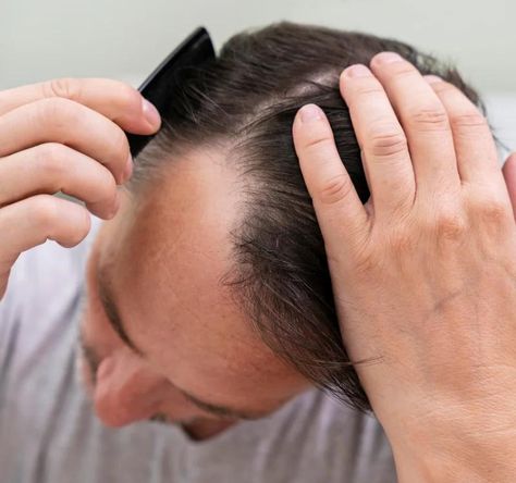 A man combing his hair, focusing on a receding hairline, showing thinning hair near the top of his head, highlighting hair loss. Shatavari Benefits, Excessive Hair Fall, Hair Fall Problem, Hormonal Imbalances, Ayurvedic Remedies, Hair Issues, Nutritional Deficiencies, People Struggle, Hair Texture