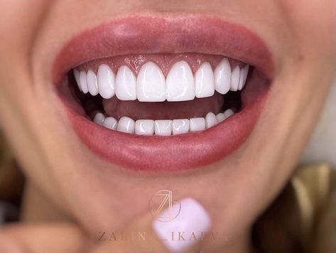 Teeth Aesthetic, Pretty Teeth, Veneers Teeth, Beautiful Teeth, Straight Teeth, Perfect Teeth, Facial Aesthetics, Smile Teeth, Smile Design