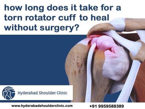 How long does it take for a torn rotator cuff to heal without surgery? Exercises For Torn Rotator Cuff, Torn Rotator Cuff Surgery, Rotator Cuff Tear Exercises, Rotator Cuff Tendinosis, Torn Rotator Cuff Relief, Exercises For Rotator Cuff Pain, Rotator Cuff Surgery Recovery Tips, Torn Rotator Cuff Exercises, Torn Rotator Cuff Symptoms