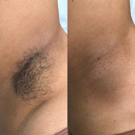 Hairless, smooth underarms is definitely a plus! Whatcha think!?? 509-961-6555 #underarmwax #hairfree #waxstudio #hairless #waxspecialist #yakima #bebare #bodywaxspecialist #nomorehair #bodywax #femalewaxing #malewaxing #yakimawaxing #fromheadtotoe #barebliss #beauty #bodywaxing #waxingstudio #waxingspecialist #waxingyakima #fullbodywax #underarmwaxing #hairremoval #fullbodywaxing Female Waxing, Male Waxing, Underarm Waxing, Full Body Wax, Wax Studio, Remedies For Acne, Waxing Tips, Healthy Face, Underarm Hair Removal