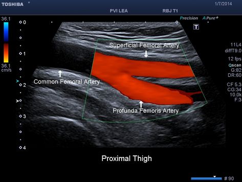 Femoral Artery, Diagnostic Medical Sonography Student, Ultrasound School, Arteries Anatomy, Cardiac Sonography, Doppler Ultrasound, Sonography Student, Vascular Ultrasound, Abdominal Aorta