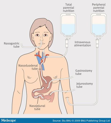 www.smileeachandeveryday.com Guide to tube feeding: TPN, NG, NJ, PEG, PEJ Gastrointestinal Nursing, Parenteral Nutrition, Medical Terminology Study, Nurse Skills, Pediatric Nurse Practitioner, Nurse Study Notes, Nursing School Survival, Nursing School Studying, Nursing School Notes