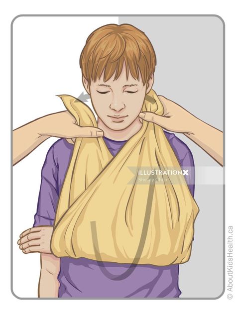 Illustration of broken hand Arm Sling, First Aid Course, Hand Exercises, Shoulder Injuries, Drawing Exercises, Kids Health, Girl Scouts, Illustrator, Two By Two