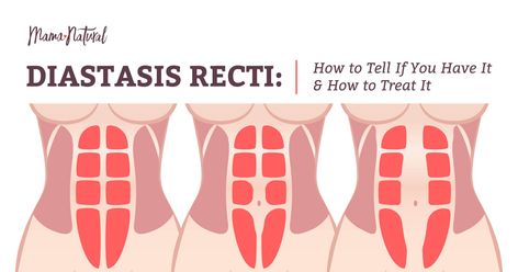 Diastasis Recti: Do You Have It? Plus How to Treat It Pregnancy Abs, Mama Natural, Diastasis Recti, After Pregnancy, Fitness Blog, Home Remedies, Health Tips, Health, Beauty