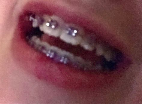 Purple Braces Aesthetic, Silver Braces Aesthetic, Braces Aesthetic Purple, Purple And Blue Braces, Dark Purple Braces, Lavender Braces, Purple Braces, Neon Pink Braces, Brackets Aesthetic