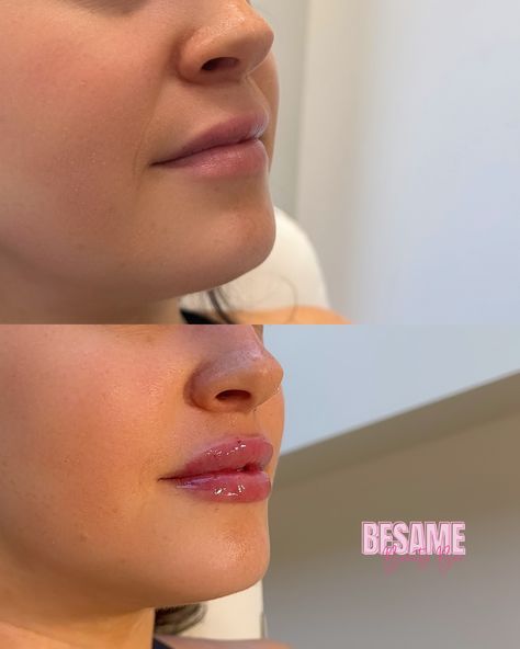 OBSESSED 😍😍😍 She had filler done 6 months ago but wanted more volume, so here we are, a full syringe later 🩵💉 If you’re waiting for a sign, this is it! ✨ Book your next lip filler appointment with me 💕 👩🏻‍⚕️Cindy H. RN, BSN | @beautynurse.cindy 📍Bésame Beauty Bar | 8080 N Central Expy Suite 1250, Dallas, TX 75206 🏥 Concierge Services Available in & around the Forney area 💉 Book using link in bio or DM 💌 DM for free consult #beautyinjector #lipfiller #dermalfillers #fullsyringe #halfsyring... It Book, Lip Filler, Dermal Fillers, Lip Fillers, Beauty Bar, A Sign, Dallas Tx, 6 Months, Dallas