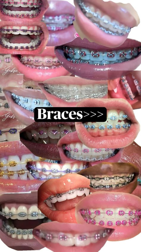 Braces Perfect Teeth Braces, Braces Colors Combinations, Cute Braces Colors, Pretty Teeth, Braces Tips, Getting Braces, Cute Braces, Brace Face, Braces Colors