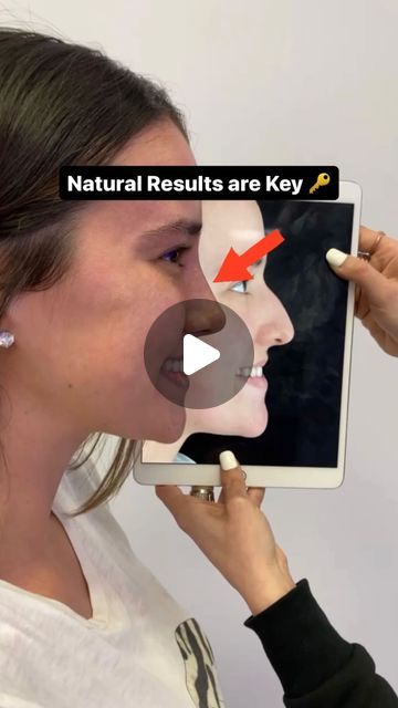 Plastic Surgeon Dr. Kassir on Instagram: "Natural results are 🔑   On Instagram people post really curvy or slope like noses and reality is most patients want a nose that fits and looks like it was always meant to be the nose they were born with   With Designer Rhinoplasty® I make sure to keep the integrity of the patients facial anatomy & help enhance features they already have 🥰  CLOSED, atraumatic technique ✨  ✅ No breaking of bones  ✅ No hammers or chisels  ✅ No packing ✅ No pain meds ✅ Minimal to no bruising   Share your thoughts, leave a comment below 🔽🔽🔽 and TAG A FRIEND.  To schedule an appointment:    ☎️ 212-288-3000  📲 WhatsApp: 201-875-8482 💌DM   Locations:  📍65 East 66th Street, New York, NY 10065 📍81 North Maple Avenue, Ridgewood, NJ 07450  #rhinoplastyny #rhinoplastyn Anatomy Help, Nose Ideas, Ridgewood Nj, Hooked Nose, Nose Types, Broken Nose, Facial Anatomy, Nose Bones, Instagram People