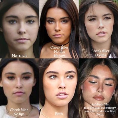 Brows And Lips Makeup, Jaw Implant Before And After, Madison Beer Plastic Surgeries, Filler Nose Job Before After, Jaw And Chin Filler, Eyebrow Botox Lift, How To Lift Your Eyes, Madison Beer Lip Fillers, Hip Filler Before And After