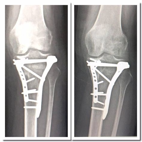 Tibial Plateau Fracture Recovery, Shelby Aesthetic, Finn Shelby, Tibial Plateau Fracture, Simple Tattoos For Guys, Surgical Technologist, Bone Fracture, Muscle Atrophy, Ankle Pain