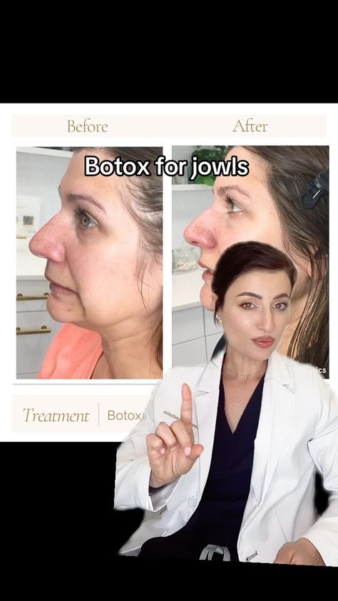 Enki Nichols | Lone Tree Aesthetics Med Spa | Botox can reduce sagging jowls by tightening and lifting the jaw area. I was so impressed with her results #dao #jowls #botox... | Instagram Dao Botox Before After, Lower Face Botox Before And After, Botox For Jowls, Botox Placement, Botox Business, Botox Instagram, Sagging Jowls, Aesthetics Business, Bulbous Nose