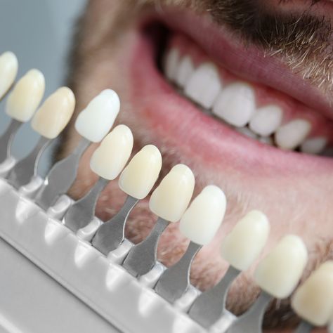 Porcelain veneers can conceal all your cosmetic concerns, such as misshapen teeth, discoloration, cracks in the teeth, gaps between the teeth, and more. Furthermore, porcelain is slightly translucent, just like enamel, so it’s indistinguishable from natural enamel.   Contact us to change your Smile: 📍17100 Collins Ave., #213 📞 305-560-5445 #SunnyIslesDental #Veneers #CosmeticDentistry Cabinet Veneer, Dental Quotes, Dental Photos, Dental Bonding, Teeth Pictures, Dental Photography, Dental Fun, Porcelain Veneers, Implant Dentistry