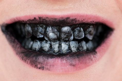 Sunburn Peeling, Teeth Aesthetic, Losing Teeth, Gore Makeup, Black Teeth, Natural Face Care, Dental Fun, Aesthetic Dentistry, Dental Facts