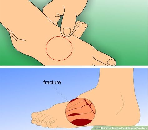 How to Treat a Foot Stress Fracture: 12 Steps (with Pictures) Metatarsal Fracture, Pt Exercises, Health Remedy, Hairline Fracture, K Tape, Psoas Release, Running Recovery, Healthy Hacks, Kt Tape