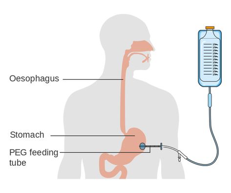 Difference Between TPN and Tube Feeding Check more at https://in4arts.com/difference-between-tpn-and-tube-feeding.html Peg Tube Feeding, Refeeding Syndrome, Gastrostomy Tube, Aspiration Pneumonia, Peg Tube, Tube Feeding, Psychological Effects, Feeding Tube, Mobility Aids