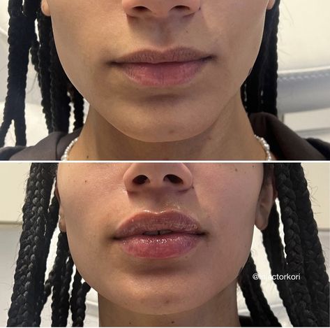 Lip Filler Shape Ideas Black Women, 1.5 Ml Lip Filler, Lip Filler Before And After Black Women, Botox And Fillers Before After, Lip Filler Before And After 1ml, Natural Lip Fillers 1ml, Lip Filler Black Women, Light Lip Filler, Upper Lip Filler