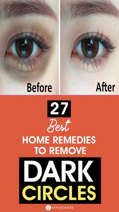 Remedies For Dark Circles, Beauty Hacks That Actually Work, Dark Circle Remedies, Dark Circles Around Eyes, Dark Eye Circles, Remove Dark Circles, Dark Circles Under Eyes, Dark Circle, Undereye Circles