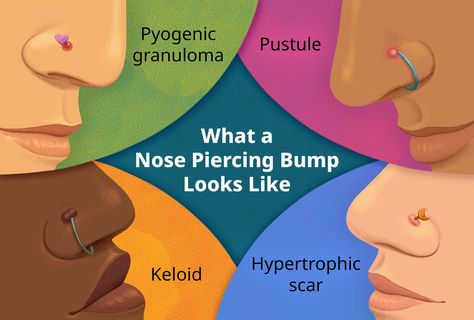 Piercing Ideas Nose Stud, Nose Piercing Irritation Bump, How To Get Rid Of Nose Piercing Bump, Nose Piercing Bump Remedies, How To Get Rid Of Piercing Bumps Fast, Bump On Nose Piercing, Piercing Bump Remedy, Nose Piercing Infection, Nose Piercing Healing