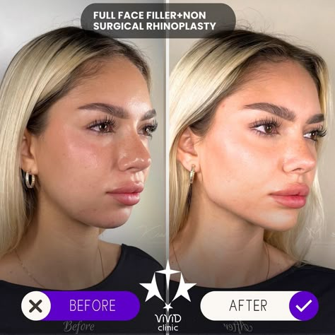 💉✨ Sculpt and define your face with Jawline Filler at Vivid Clinic! Check out this stunning Client Transformation—perfectly contoured, sharper jawline for a more defined and balanced appearance. 💎 ✅ Enhances facial definition ✅ Non-surgical with immediate results ✅ Long-lasting, natural-looking transformation 💬 Want to achieve a similar look? Book your free consultation today and take the first step toward a more sculpted you! 📍Located in Istanbul, Turkey 🌐 vividclinic.net 📞 🇺🇸 +90 545 742... Jawline Contouring Filler, Chin And Jawline Fillers, Facial Contouring Fillers, Facial Balancing Before And After, Jaw Filler Before And After, Face Balancing Fillers, Jawline Fillers Before And After, Facial Balancing Filler, Facial Definition