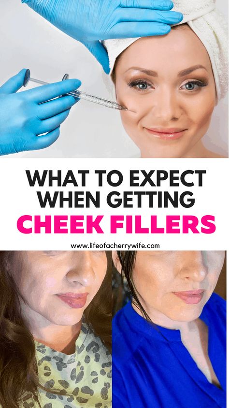 Filler In Cheeks Before And After, Check Filler Before And After, Face Fillers Before And After Cheeks, Before And After Cheek Filler, Cheek Filler Before And After, Facial Fillers Before And After, Cheekbone Filler Before And After, Face Fillers Before And After, Cheek Fillers Before And After Face