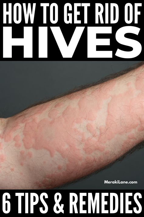 How to Get Rid of Hives: 6 Natural Remedies that Help How To Treat Hives, Natural Remedies For Hives, Skin Rash Remedies, Allergy Hives, Home Remedies For Hives, Hives Rash, Home Remedies For Rashes, Types Of Skin Rashes, Hives Remedies