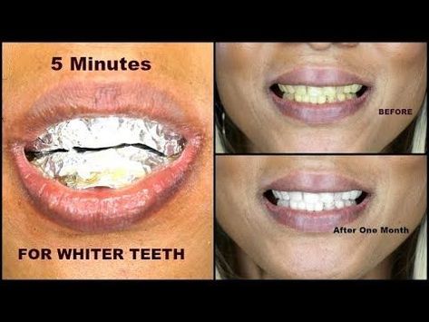 Khichi Beauty, White Teeth Diy, Make Teeth Whiter, Diy Teeth, Natural Teeth Whitening Diy, Teeth Whiting At Home, Activated Charcoal Teeth Whitening, Teeth Whitening Diy, Charcoal Teeth Whitening